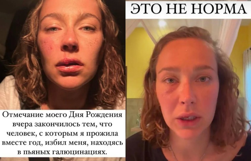 Посварилися через війну: російську актрису побив бойфренд з України (ФОТО) - фото 2