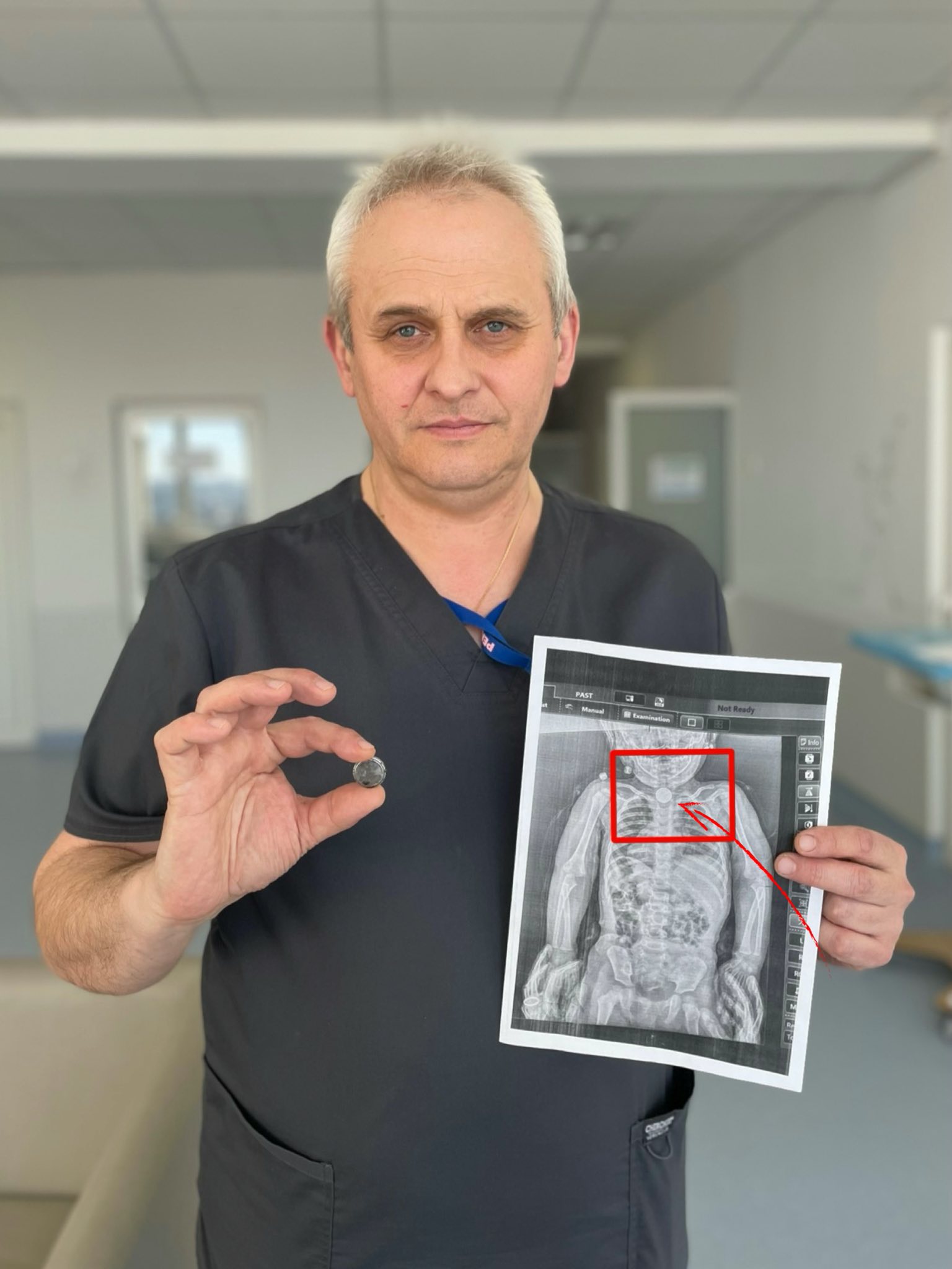 Дворічна дитина у Львові прожила всю зиму з батарейкою у стравоході: що сталося далі - фото 2