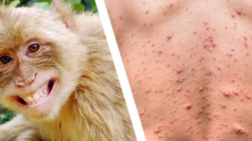 В Россию пришла оспа обезьян: что известно о смертельной болезни В Россию пришла оспа обезьян: что известно о смертельной болезни