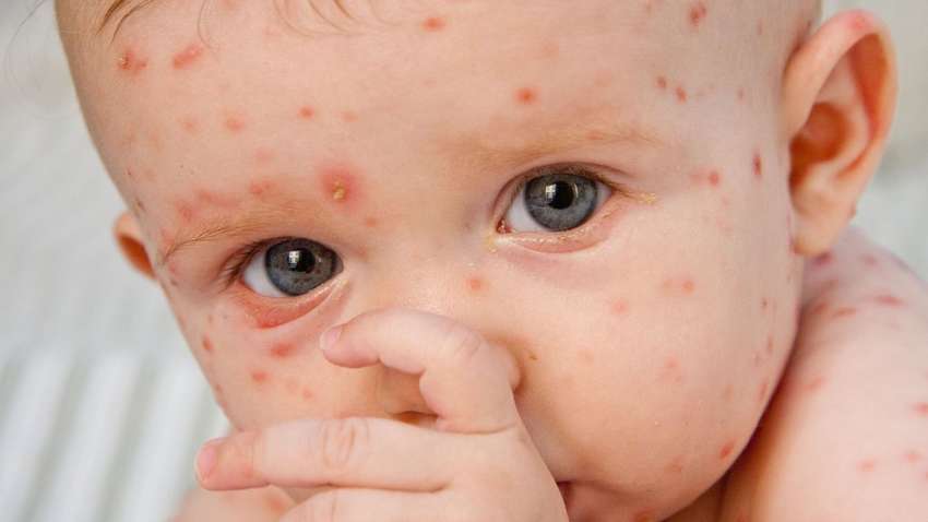 У США зареєстровані рекордні за 26 років спалахи кору