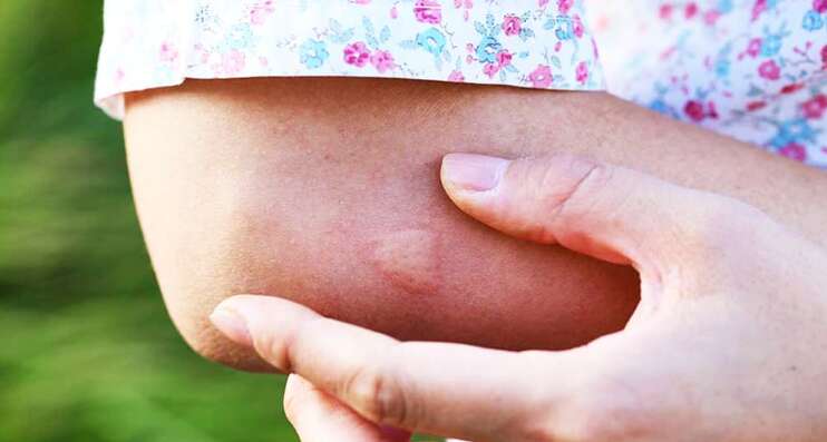 Комариный укус со страшными последствиями: на Львовщине из-под кожи женщины извлекли огромного паразита (ФОТО)