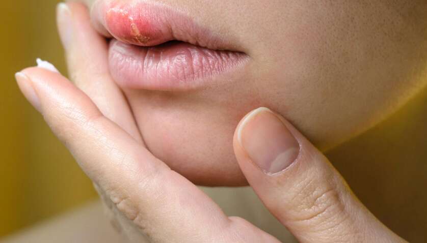 Як швидко позбутися герпесу: названі найефективніші методи