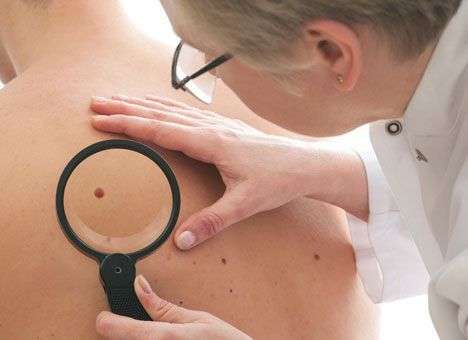 Почему можно умереть из-за родинки и как этого избежать