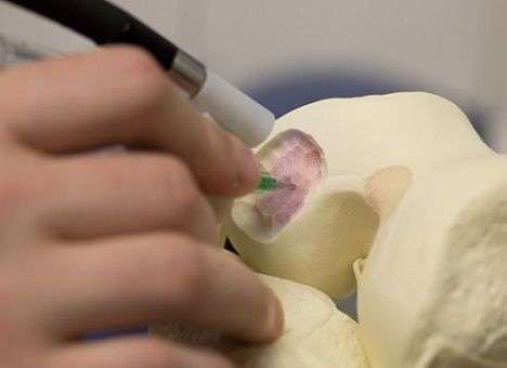 «Биоручка» позволит «рисовать» имплантаты во время операции