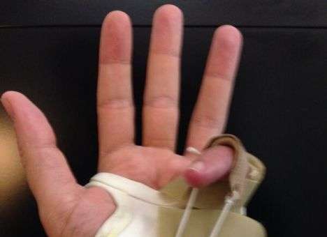 Посол США в России сломал еще один палец