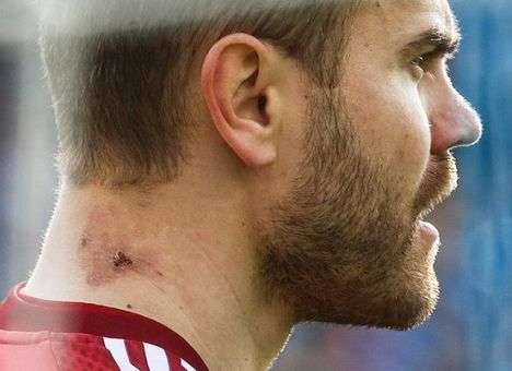 В интернете появился снимок Акинфеева с ожогом от файера (ФОТО, ВИДЕО)