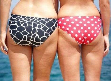 Врачи одобрили наличие целлюлита