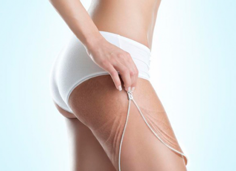 Врачи развенчали мифы о целлюлите