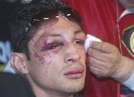 Экс-чемпион мира по боксу может лишиться глаза