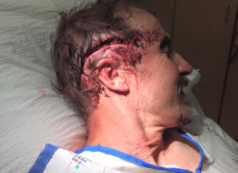 Кровь заливала глаза: Американец пережил два нападения медведицы (ВИДЕО)