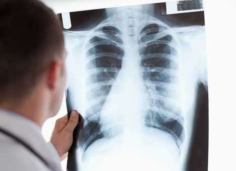 Украина в тридцатке лидеров по заболеванию туберкулезом