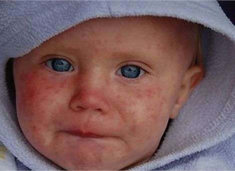 Украине угрожает эпидемия кори