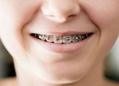 Стоматологи рассказали, чем опасны брекеты для зубов и десен