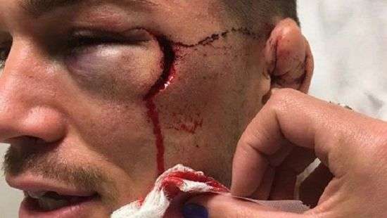 Ужасное рассечение бойца ММА после нокаута (ВИДЕО)