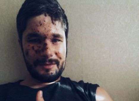 Раненный британский журналист показал свое фото в больнице Мечникова
