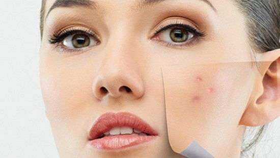 Причину появления акне выяснили ученые