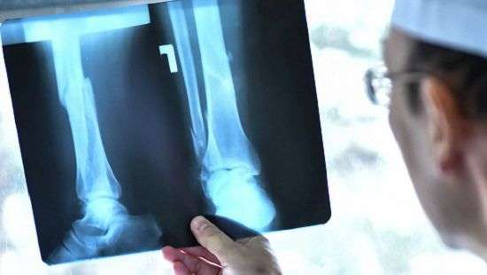 Как предотвратить переломы костей у пожилых людей, выяснили специалисты