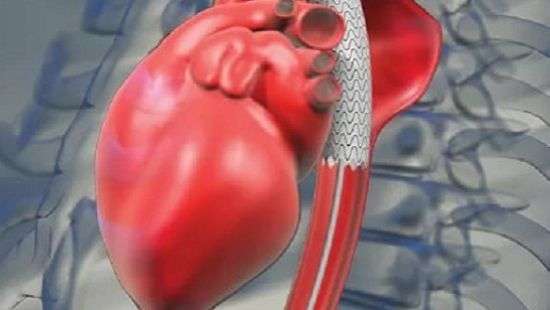 Новый метод лечения аневризм придумали медики