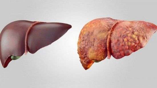 Новый способ лечения цирроза печени нашли специалисты