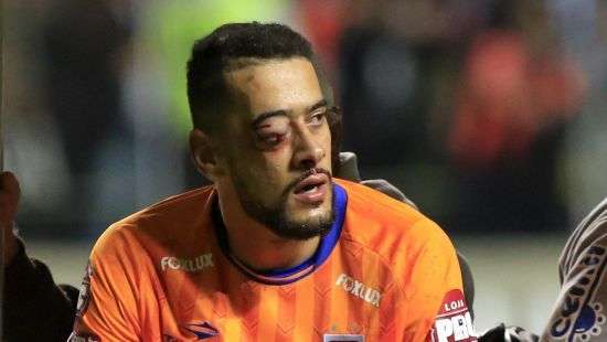 Вратарю вживили в лицо две титановые пластины