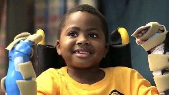 Специалисты провели успешную пересадку обеих рук ребенку (ВИДЕО)