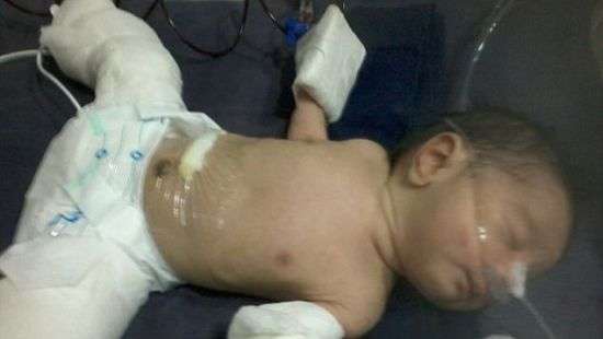 В Индии родился мальчик беременный своим братом (фото)