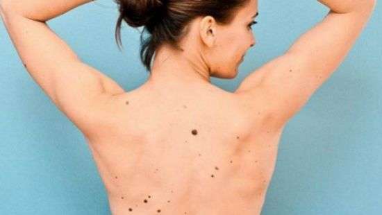 Что предшествует появлению злокачественных родинок, выяснили дерматологи