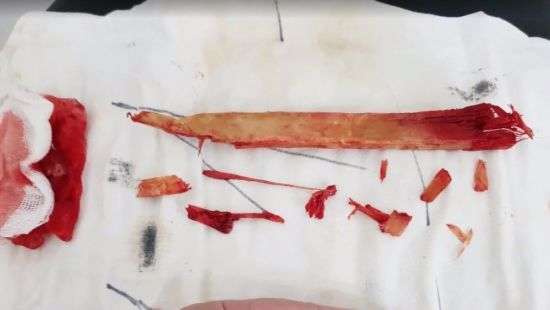 Медики провели уникальную операцию достав из шеи мужчины деревяшку в 25 см (видео)