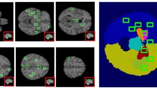 ИИ научили обнаруживать болезнь Альцгеймера