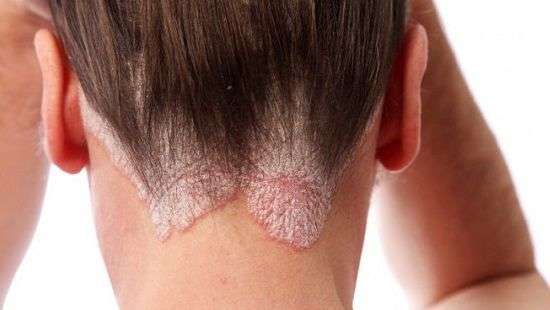 Врачи выяснили, как вылечить псориаз