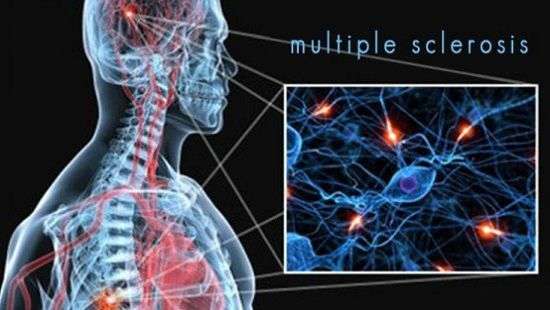 Как замедлить развитие рассеянного склероза, рассказали врачи