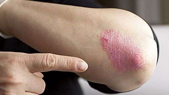 Дерматологи назвали 5 фактов о псориазе, которые нужно знать каждому