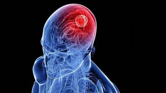 Медики научились лечить метастазы в мозгу