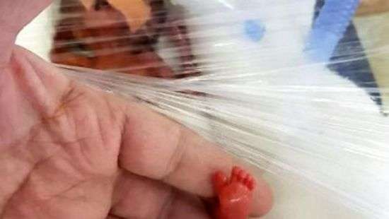 В Индии врачи спасли малыша, размером с ладонь (ФОТО)