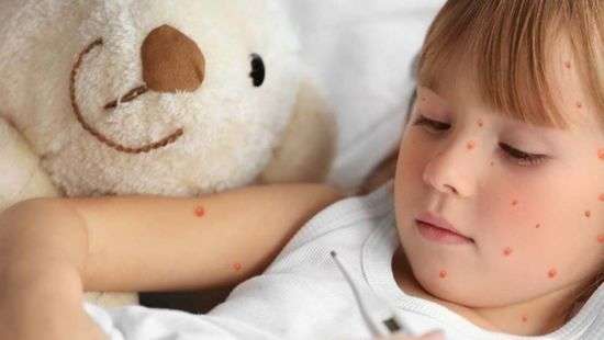 Стало известно, откуда в Украину пришла корь