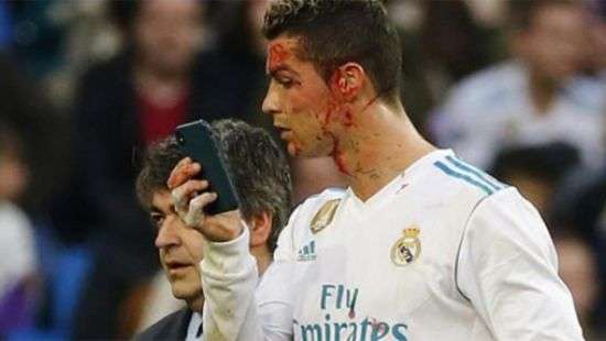 Роналду разбили лицо