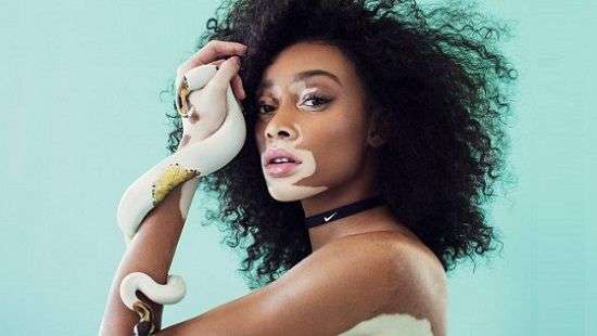 Медики назвали причины и способы лечения витилиго