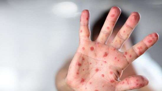 Во Франции скончался заболевший корью пациент