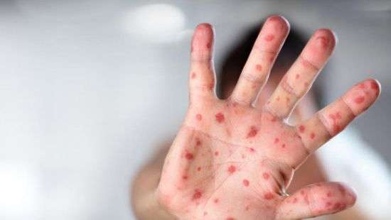 Жителям оккупированных территорий Донбасса грозит вспышка кори