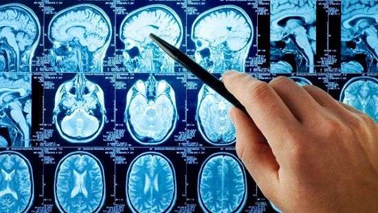 Медики научились диагностировать инсульт за 30 секунд