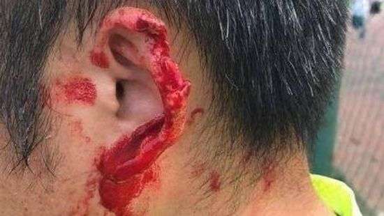 Футболисту откусили часть уха