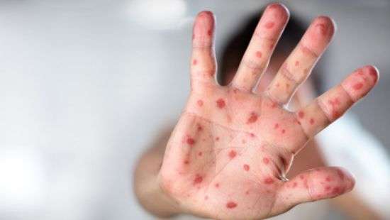 В Закарпатской области зафиксировали вспышку кори: госпитализированы 49 школьников