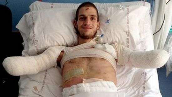 Из-за ошибки врачей итальянцу ампутировали руки и ноги (ФОТО)