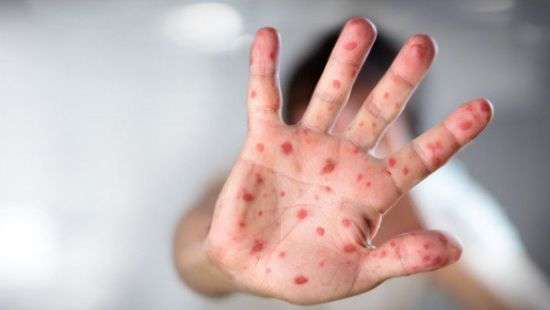 С начала года корью заболели почти 7 тыс. взрослых и 10 тыс. детей