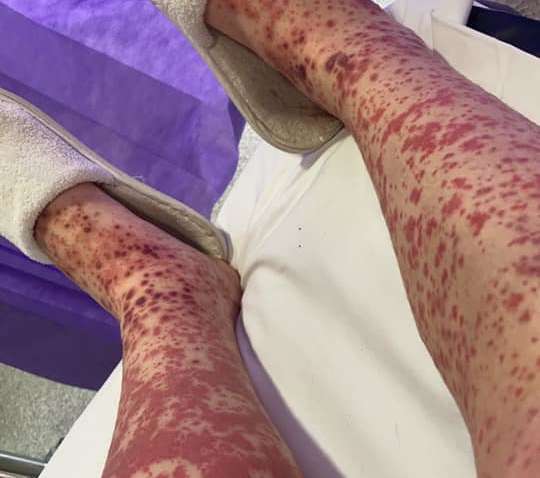 У Британії дівчина отримала розрив вен і опинилася в інвалідному кріслі після вакцинації від коронавируса