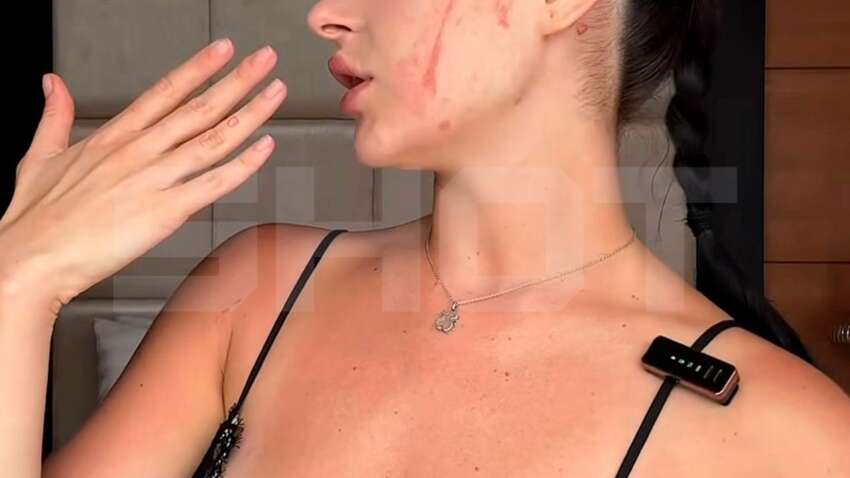 Чуть не ослепла во сне: москвичка пострадала во время отдыха в Индонезии