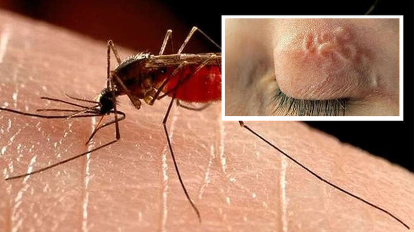 Комариный укус с ужасающими последствиями: в Запорожье из-под века пациента извлекли паразита Комариный укус с ужасающими последствиями: в Запорожье из-под века пациента извлекли паразита