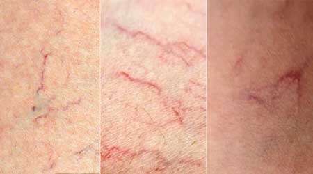 Эти «сеточки» на теле сигнализируют о болезнях Эти «сеточки» на теле сигнализируют о болезнях