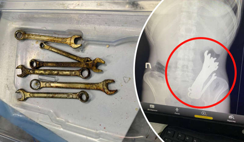 В Черкасской области врачи спасли мужчину: он проглотил шесть гаечных ключей В Черкасской области врачи спасли мужчину: он проглотил шесть гаечных ключей