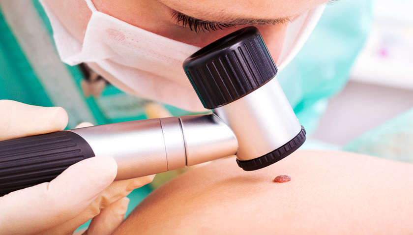 Вчений назвав небезпечну кількість родимок на тілі